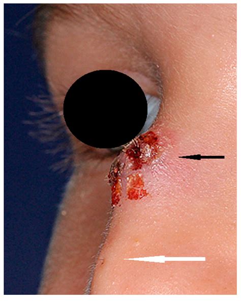 The Differential Diagnosis of Congenital Developmental Midline Nasal Masses: Histopathological ...