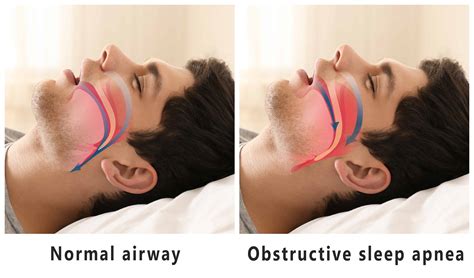 Sleep Apnea diagram - VA Claims Insider