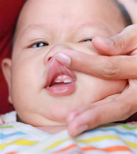 Baby Lip Blisters: Causes, Symptoms, And Treatment
