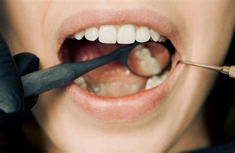 Candidiasis oral: 6 datos que debes saber