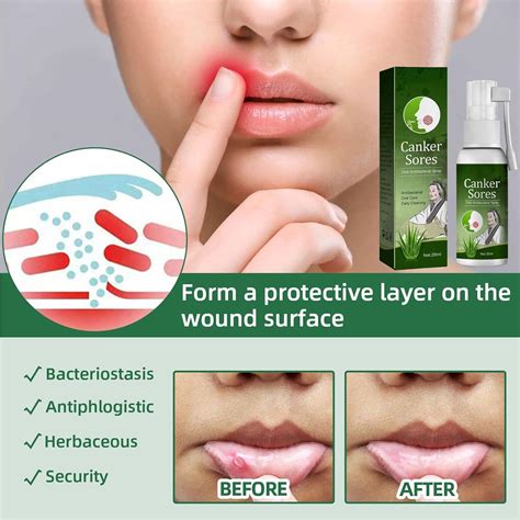 Oral Ulcer Relief Spray 20ml - Canker Sore & Gum Pain Relief Treatment | Buy Now with Express ...