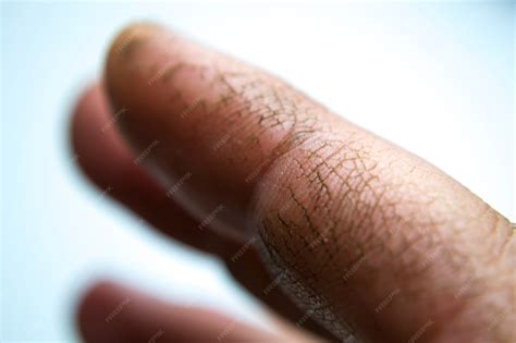 Premium Photo | Extremely dry dehydrated and cracked skin of a mans hand with fragments of ...