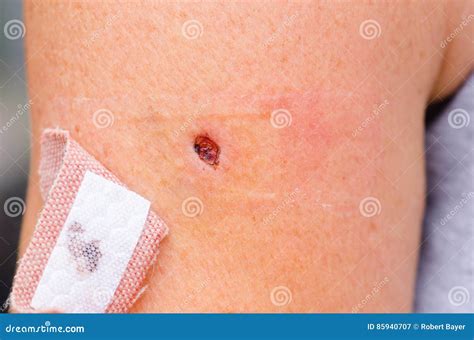 Wound Scab Not Healing at Phyllis Mosier blog