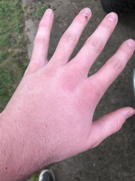 Yellow Jacket Sting Hand