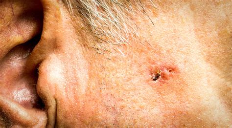 Signs Of Skin Cancer On Ear at Ruby Lay blog