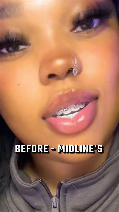 Jaw surgery ruined my face (before/after) : r/jawsurgery