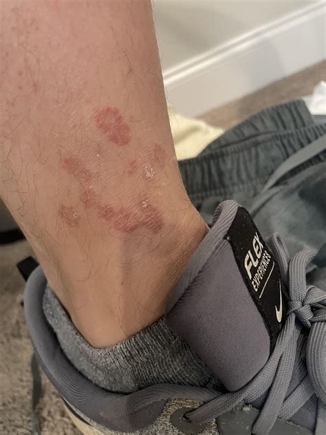 Weird rash that is immune to Lotrimin : r/DiagnoseMe