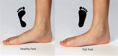 Flatfoot vs. Normal Foot: Key Differences Explained