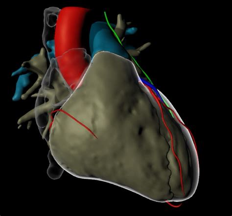 Ventricular Tachycardia Treatment | New Jersey