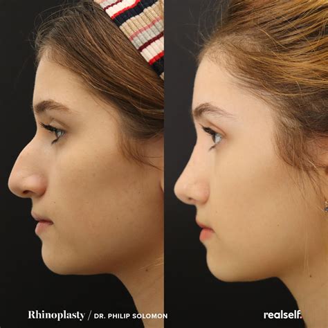 How Long After A Nose Job Can You Drink at Adam Ross blog