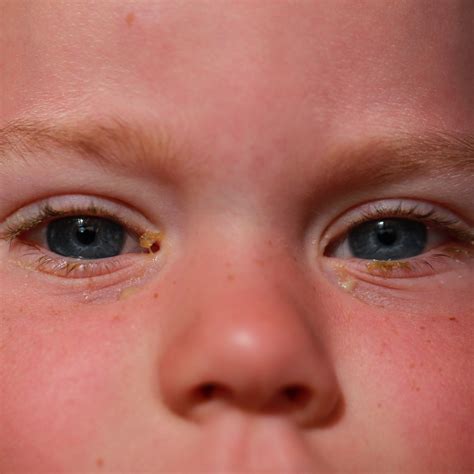 What is conjunctivitis? — THE PEDIATRICIAN MOM