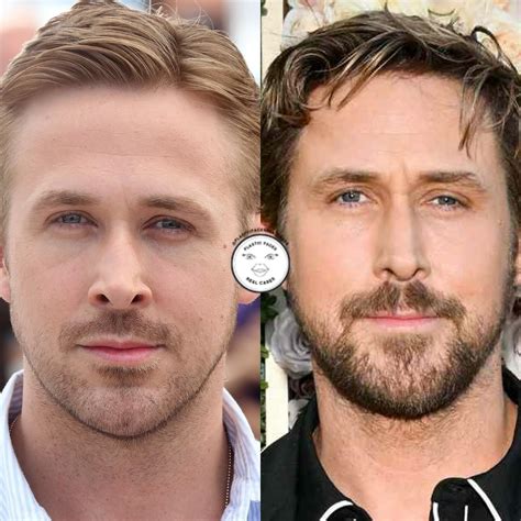 Ryan Gosling Surgery Face