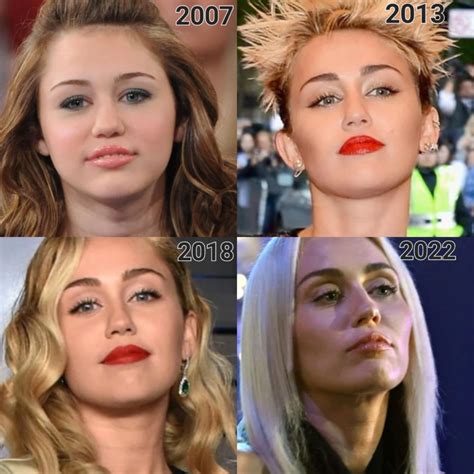 Miley Cyrus Facial Surgery