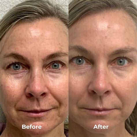 RF Microneedling Before & After Results