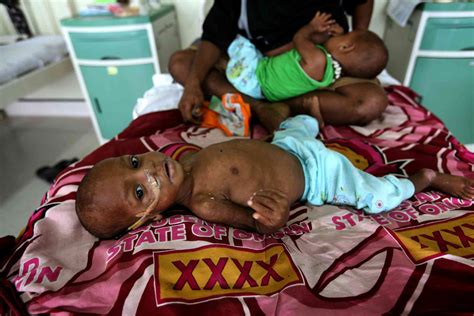 Stunted growth ‘and’ obesity: the double burden of poor nutrition on our doorstep