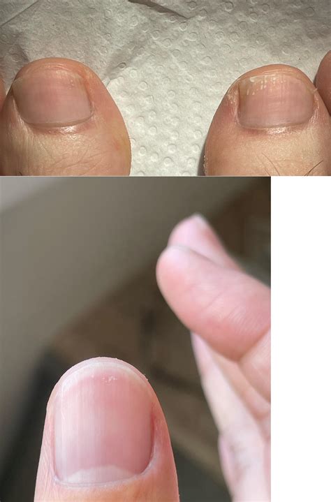 Worried about these white spots on toenails (and smaller ones on thumb) : r/NailFungus