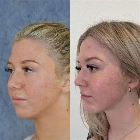 SAGAR PATEL MD Buccal l Chin Lipo l Ear Pinning | Chin Implant + Skinny ...