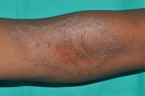 Tema 09. DERMATITIS ATÓPICA Y OTROS ECZEMAS - Dermatopharm