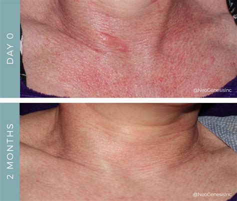 Rosacea On Chest