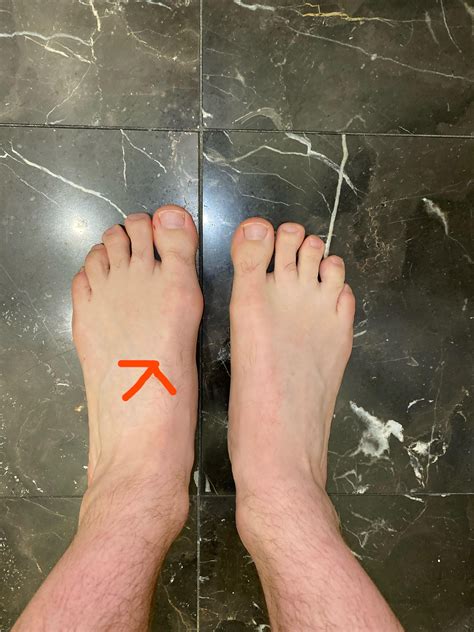 Foot atrophy and cramping : r/MuscleTwitch