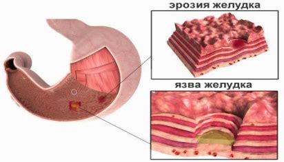 ЭРОЗИЯ ЖЕЛУДКА. ЛЕЧЕНИЕ - Kupffer BiothechKupffer