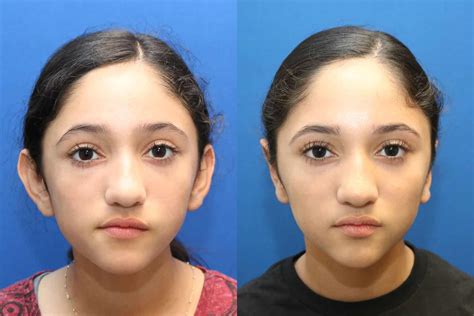 Otoplasty in Scottsdale | Ear Pinning Surgery Phoenix