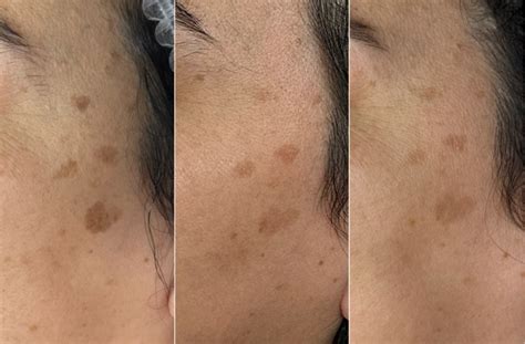 Toronto Liberty Village - Laser Genesis - IPL - Hyperpigmentation - Acne - Beauty Room