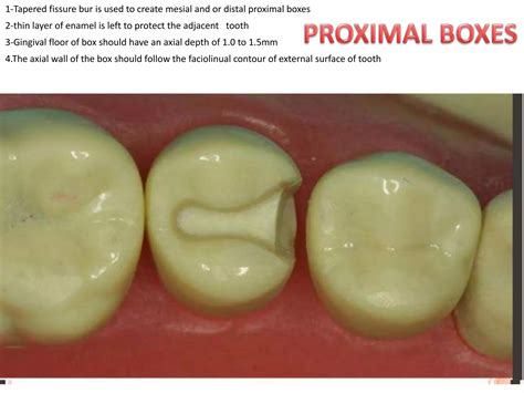 Inlays and Onlays | PPTX