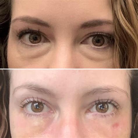 Top 95+ Pictures Lower Blepharoplasty Recovery Photos Day By Day Updated