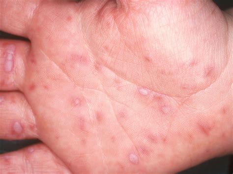 Top Viral Rashes in Babies: Symptoms, Causes, and When to Seek Help