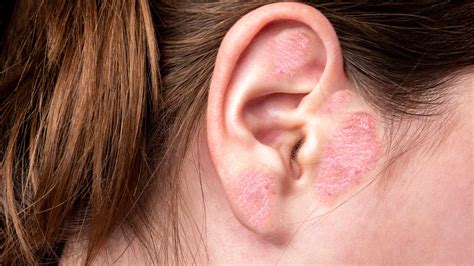 Ear Eczema: Causes, Symptoms & Treatment Options