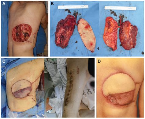 Anterolateral Thigh Chimeric Flap: An Alternative Reconstructive Option ...