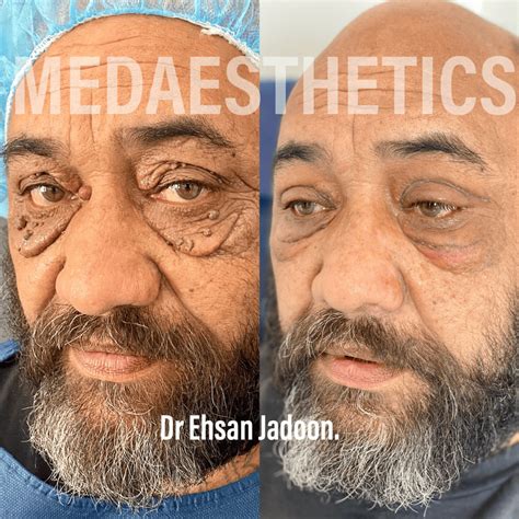 Laser Wart Removal Perth | MedAesthetics