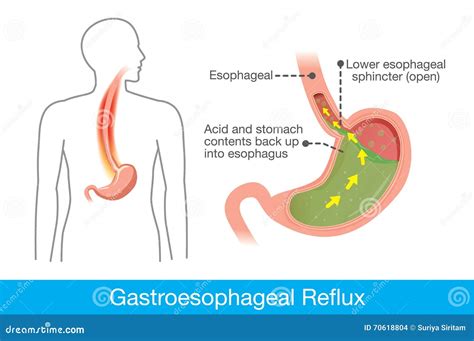 Cause of Gastroesophageal Reflux Disease in Human Stomach Stock Vector - Illustration of ...