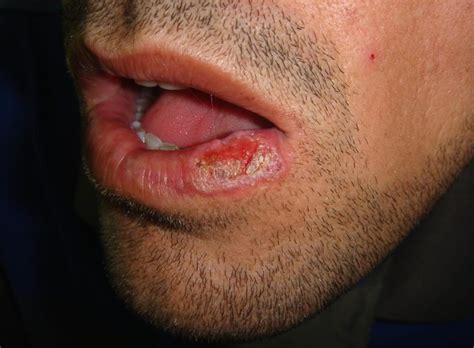 Oral Lichen Planus - Causes, Symptoms, Prognosis, Diagnosis, Treatment