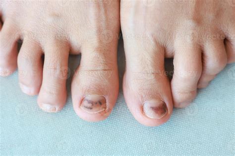 Subungual Hematoma on toenail are injuries of wearing shoes that are ...