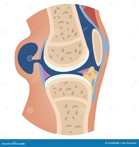 Baker S Cyst. Anatomy of the Knee with Damage To the Articular Capsule ...