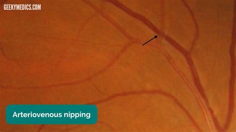 Examination of the Eyes and Vision - OSCE Guide | Geeky Medics