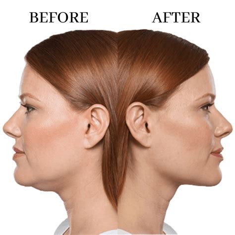 How to get rid of a double chin no surgery required – Artofit