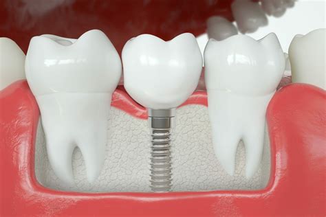 What Does A Dental Implant Crown Look Like at Kevin Christensen blog