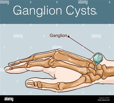 Ganglion cyst hi-res stock photography and images - Alamy