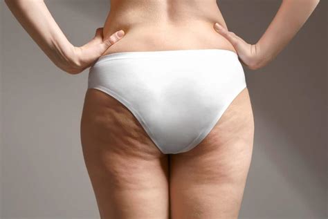 Cellulite Treatment: DIY Methods Vs. Endolift Laser Treatment