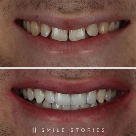 Invisalign Gap In Front Teeth 4 Methods For Closing Gaps Between Teeth