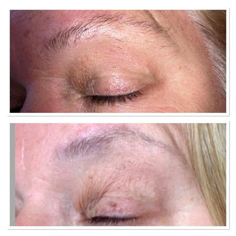 Skin Tag Removal - Fareham - Dermatouch Skin Clinic