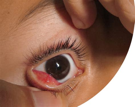 Cysts On Eyes Treatment