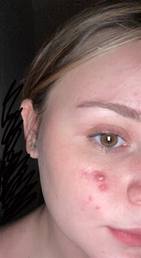 Recurrent acne on one part of my face. They always always come back. But they look so bad ...