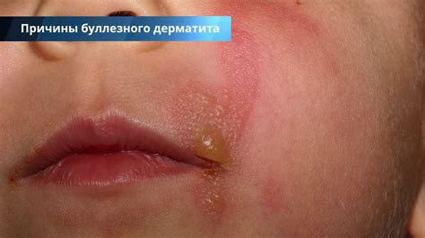 Пузырчатый дерматит на руках (буллезные высыпания): что это такое ...