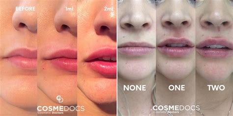 What Does 0.5Ml Lip Filler Look Like at Randy Stambaugh blog