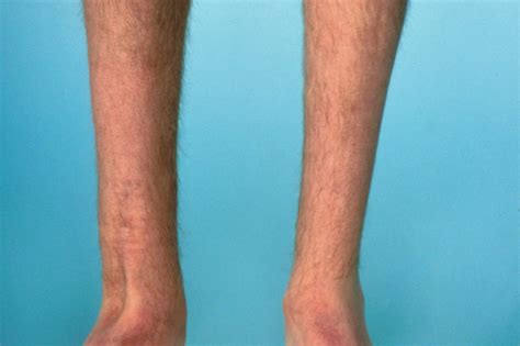 Spinal Muscular Atrophy: Early Diagnosis for Proactive Management