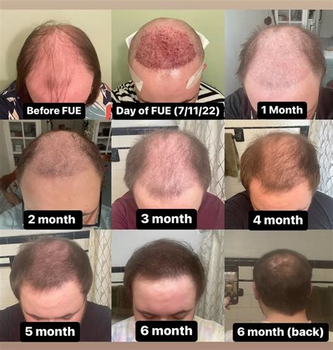 Expected Results and Treatment Timeline